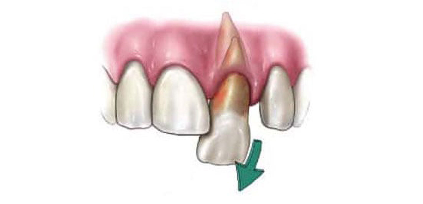 Contact our dentist immediately for traumatic injuries near Leland, NC such as knocked out tooth. Knocked Our Tooth near Leland, NC