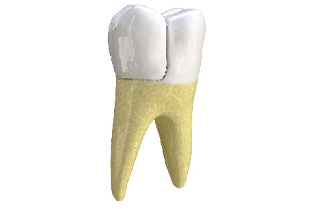 Cracked Teeth in Leland, NC