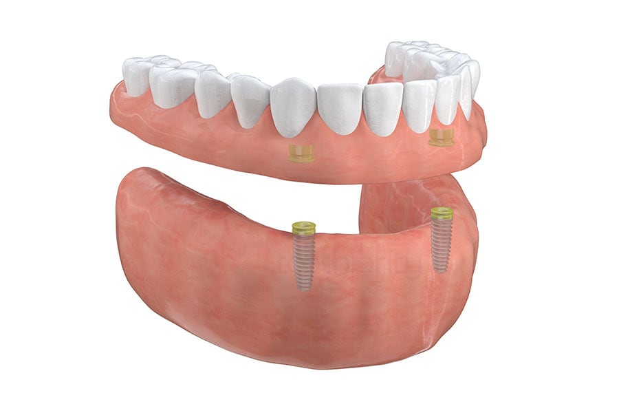 Implant-Supported Overdentures in Leland, NC