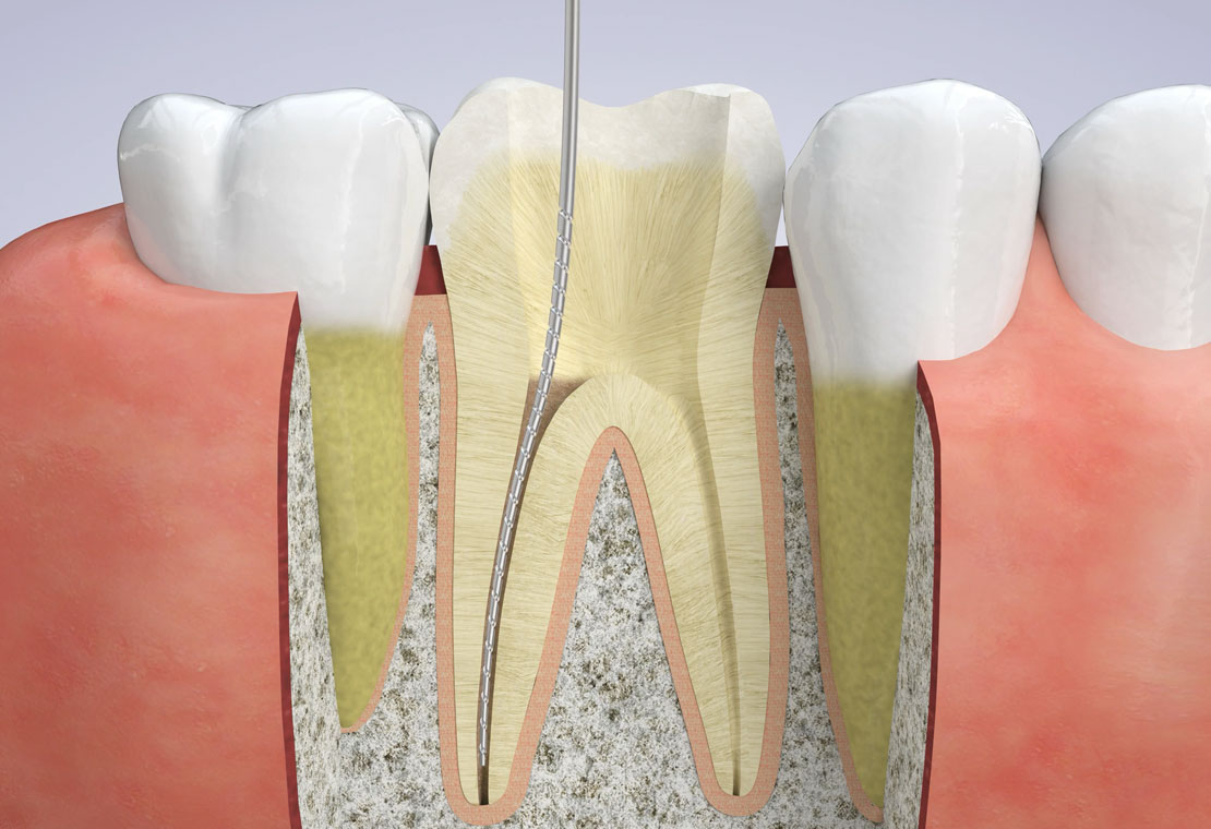 Root Canal Therapy in Leland, NC